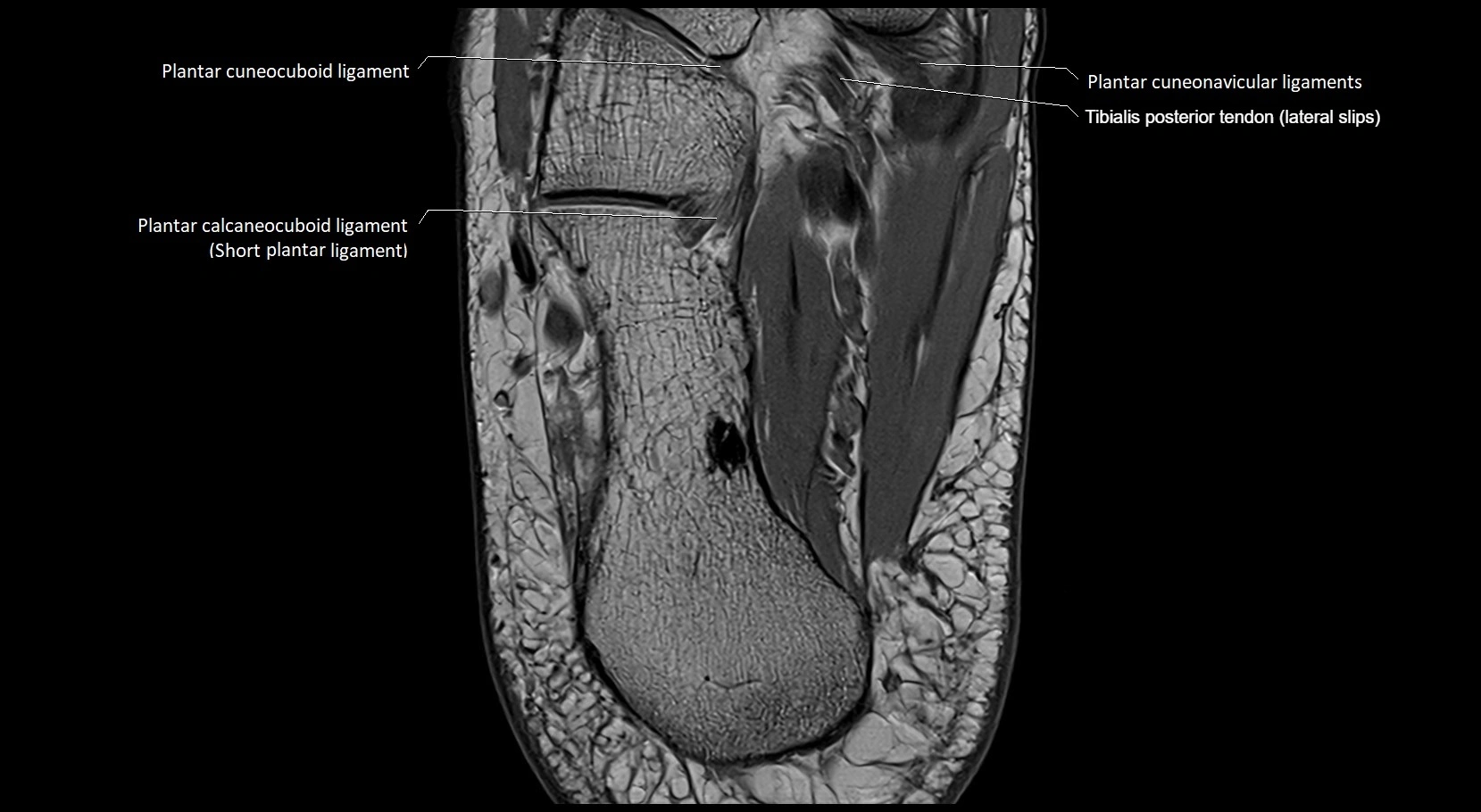 MRI ankle ligaments anatomy axial 3T image 24.webp